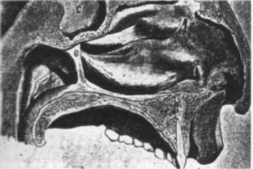 Рисунок 4. Интратурбинальная резекция кости и паренхимы нижней носовой раковины через вертикальный разрез (а) головки раковины (по Freer, 1911)